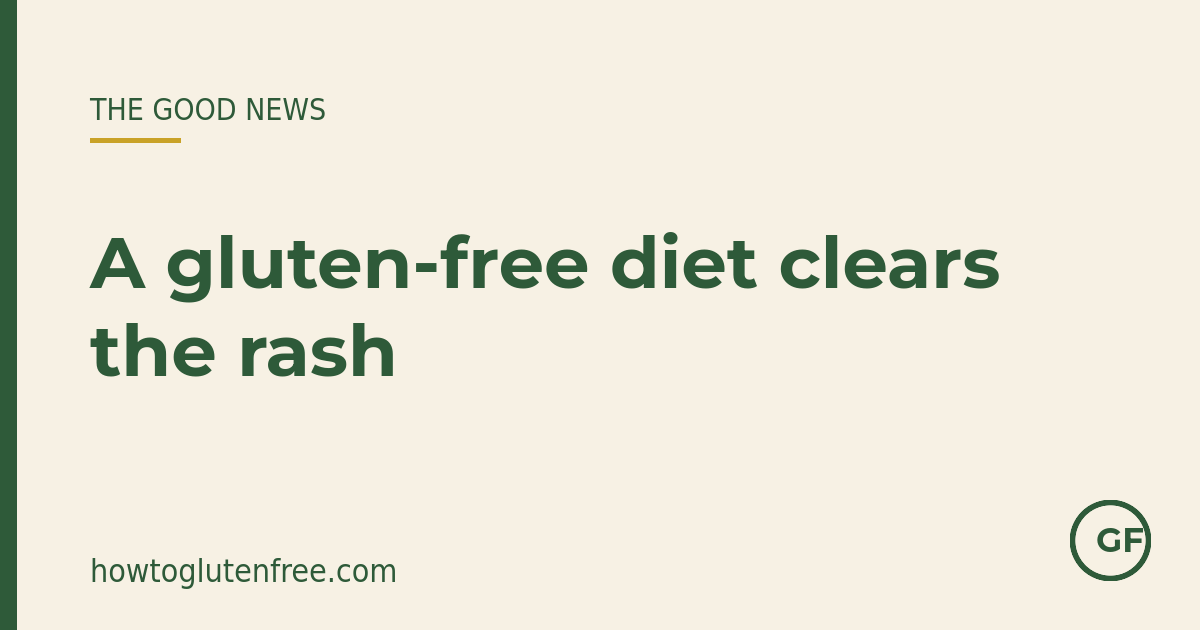 A strict lifelong gluten-free diet is the treatment that clears the dermatitis herpetiformis rash over time